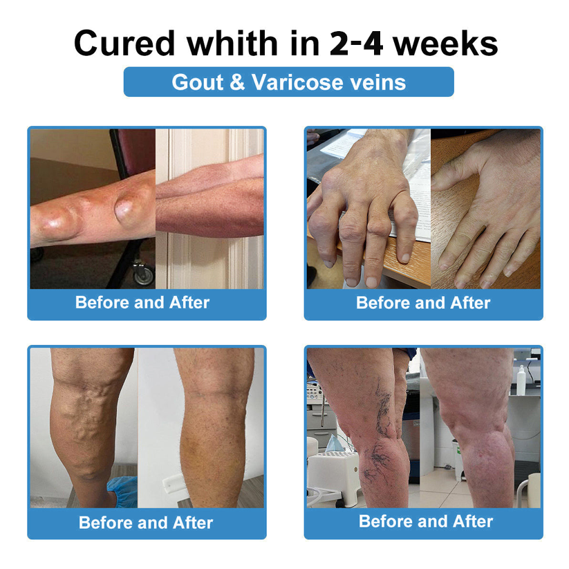Official Store：👩‍⚕️Recommended by AAOS🦾ODALIT® Nano-microneedle joint patch (Painless, long-lasting, suitable for arthritis, varicose veins and various orthopedic diseases)