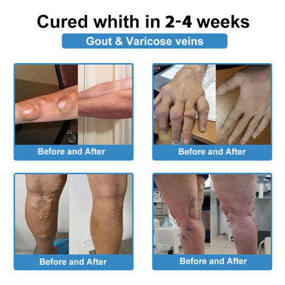 Official Store：👩‍⚕️Recommended by AAOS🦾ODALIT® Nano-microneedle joint patch (Painless, long-lasting, suitable for arthritis, varicose veins and various orthopedic diseases)