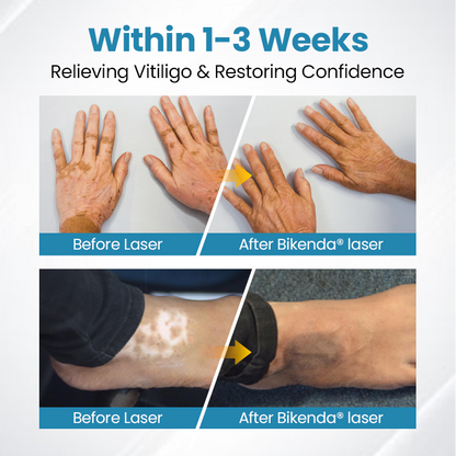 Bikenda® Evena Advanced Vitiligo Therapy Device