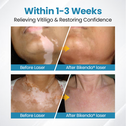 Bikenda® Evena Advanced Vitiligo Therapy Device