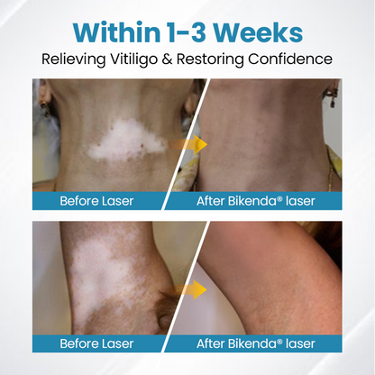 Bikenda® Evena Advanced Vitiligo Therapy Device