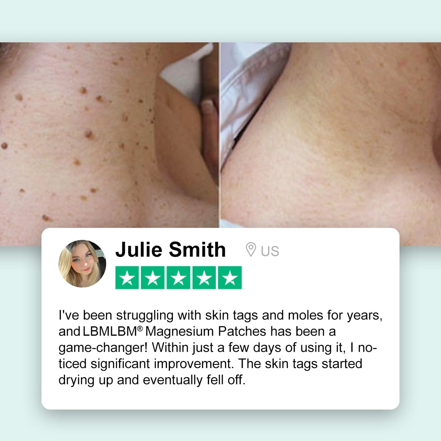 🔥LAST DAY 80% OFF - LBMLBM® Magnesium Micro-pin Wart Removal Patch