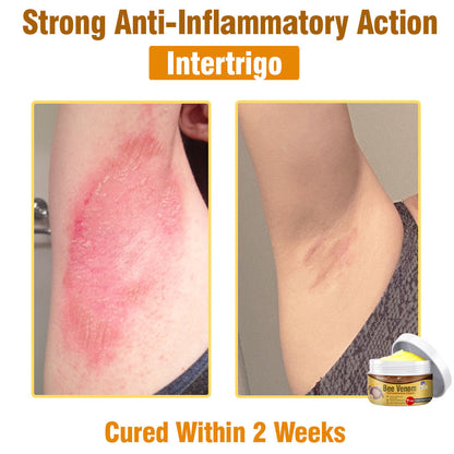 🐝 flysmus® Bee Venom Comprehensive Cream