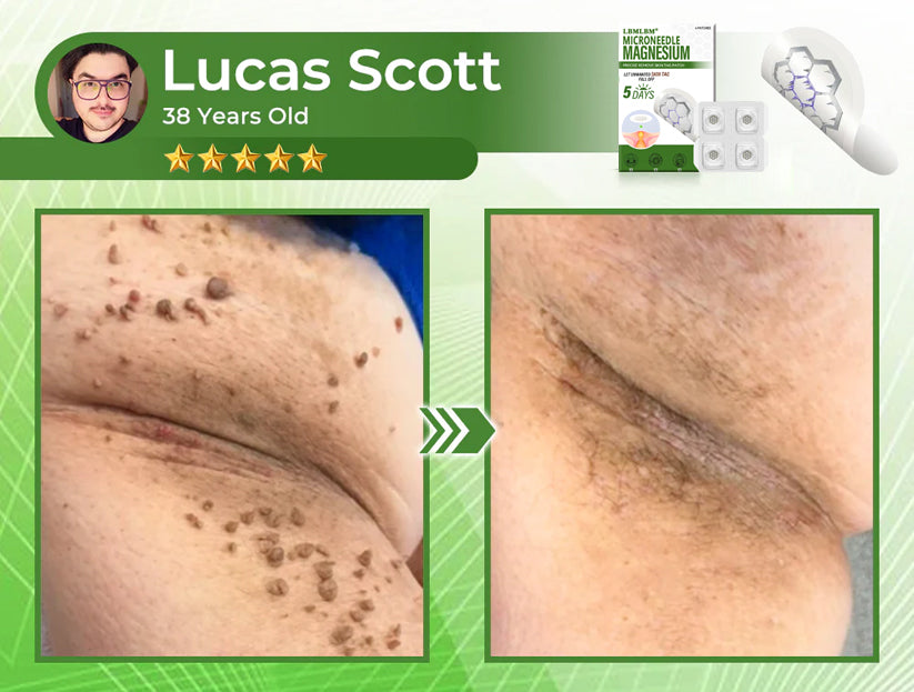 🔥Final 3 Hours: 80% OFF - LBMLBM® Magnesium MicroNeedle Precise Remove Skin Tag Patches