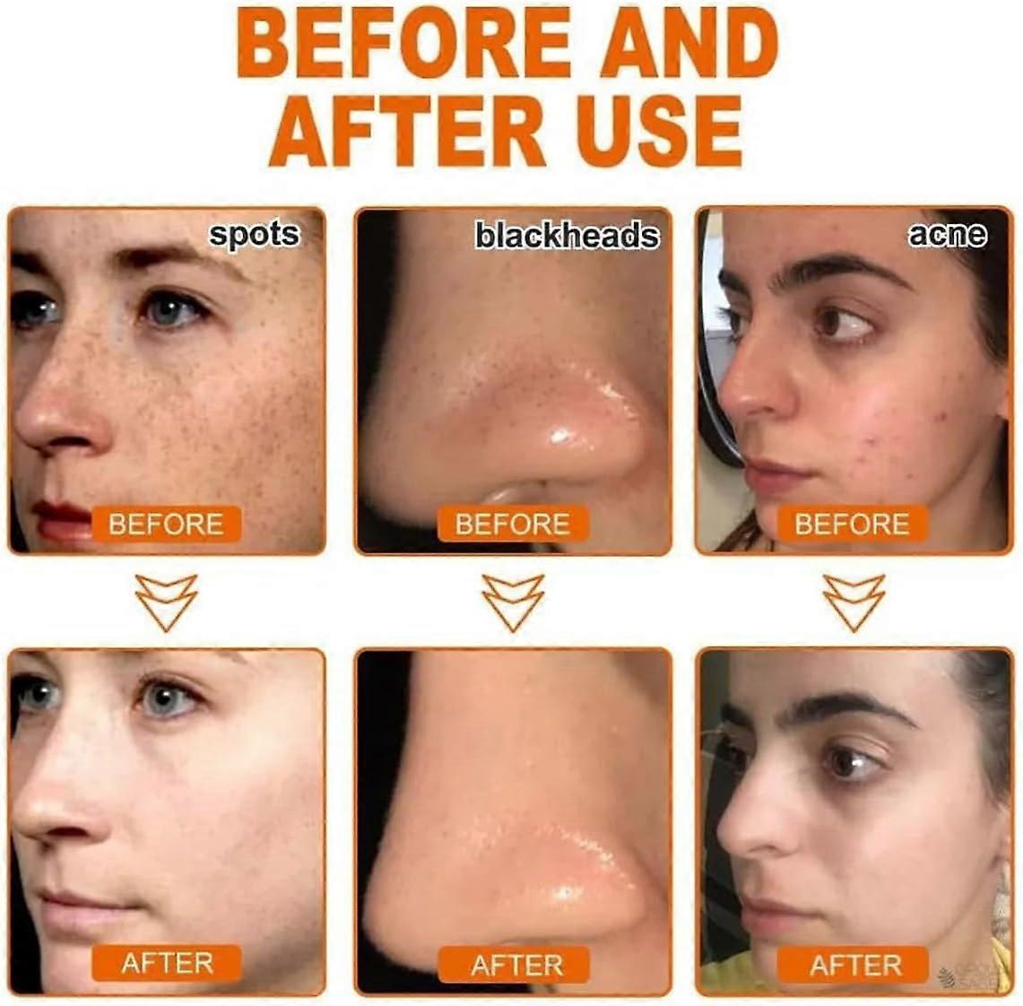 NEGUSY™ Whitening and Freckle - Removing Mask