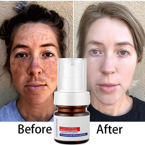 ✨FLASH SALE：⚡5-second brightening rescue: Dark spots disappear, blemishes fade, and skin becomes radiant! Vitamin C Whitening Freckles ESSENCE
