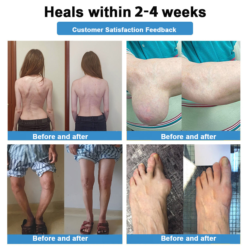 Official Store：👩‍⚕️Recommended by AAOS🦾ODALIT® Nano-microneedle joint patch (Painless, long-lasting, suitable for arthritis, varicose veins and various orthopedic diseases)