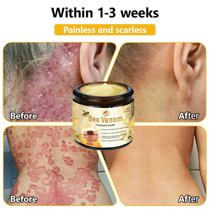 NEGUSY™ Bee Venom Skin Treatment Cream (AAD Recommended)