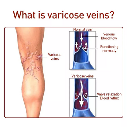 VeinRescue™ Veins Cream: Complete Treatment for Varicose Veins