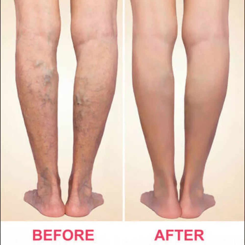 VeinRescue™ Veins Cream: Complete Treatment for Varicose Veins