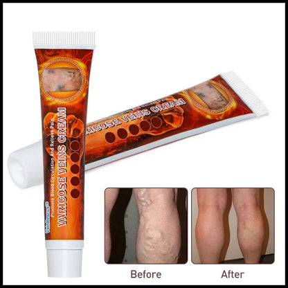 VeinRescue™ Veins Cream: Complete Treatment for Varicose Veins