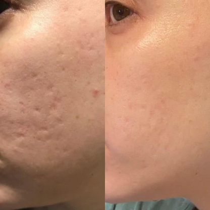 ReviveScars™ - Silicone Scar Sheets