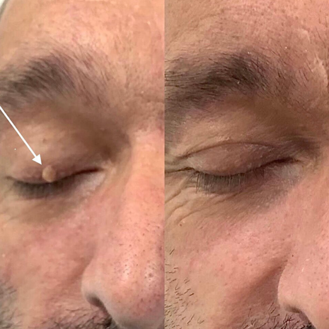 Pain-Free Cleansing Pen: Remove Skin Tags, Warts & Moles In Minutes Without Pain or Scarring