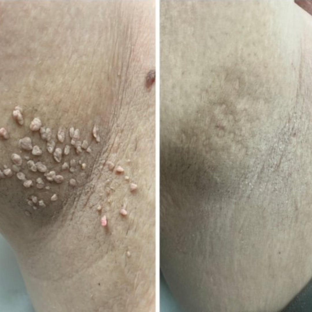 Pain-Free Cleansing Pen: Remove Skin Tags, Warts & Moles In Minutes Without Pain or Scarring