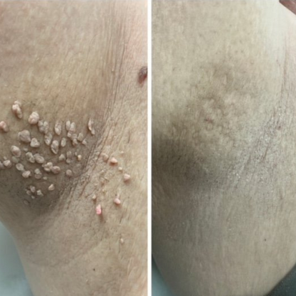 Pain-Free Cleansing Pen: Remove Skin Tags, Warts & Moles In Minutes Without Pain or Scarring