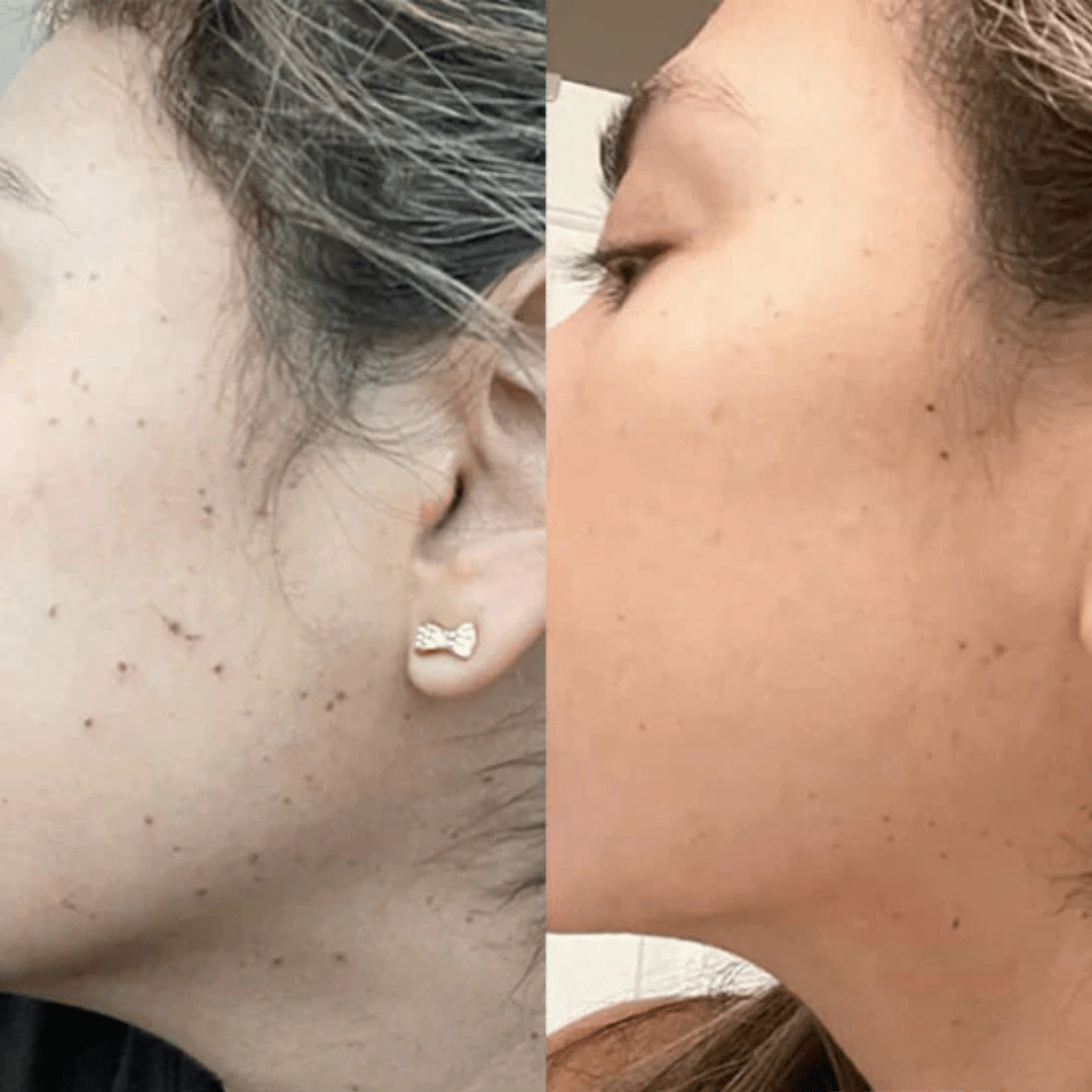 Pain-Free Cleansing Pen: Remove Skin Tags, Warts & Moles In Minutes Without Pain or Scarring