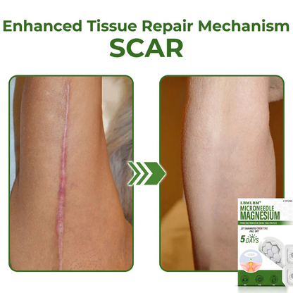 🔥Final 3 Hours: 80% OFF - LBMLBM® Magnesium MicroNeedle Precise Remove Skin Tag Patches