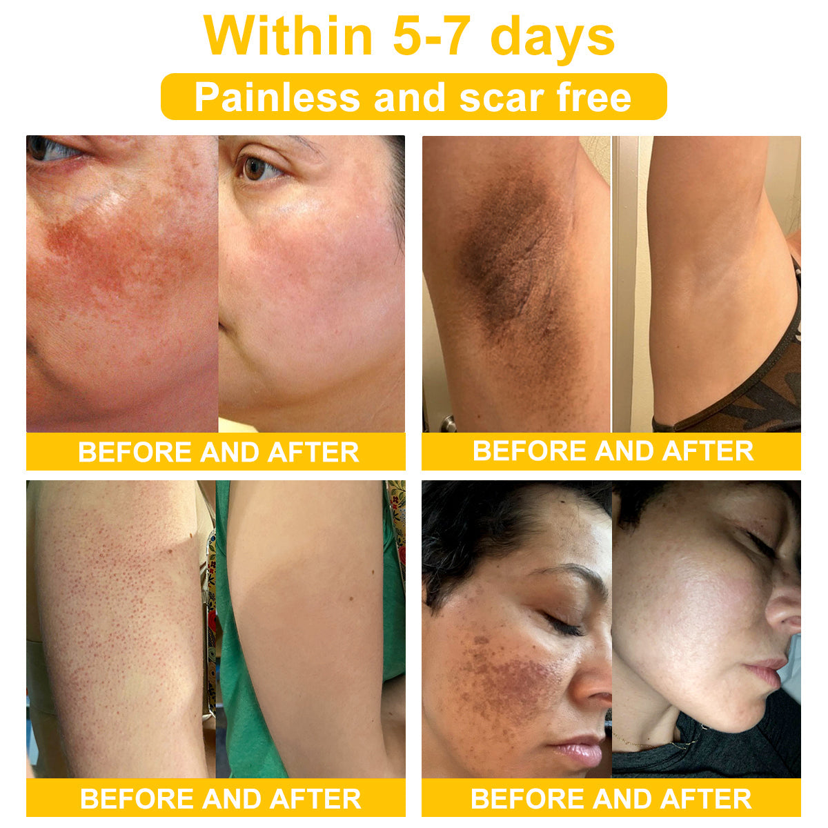 NESLEMY™ Bee Venom Skin Cream（👨‍⚕AAD Recommended),for Remove Warts, Acne and Scars