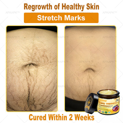Skin Tags, Eczema, or Psoriasis? This 15-Minute Bee Venom Cream Soothes, Heals & Clears Fast—No Steroids, No Scars