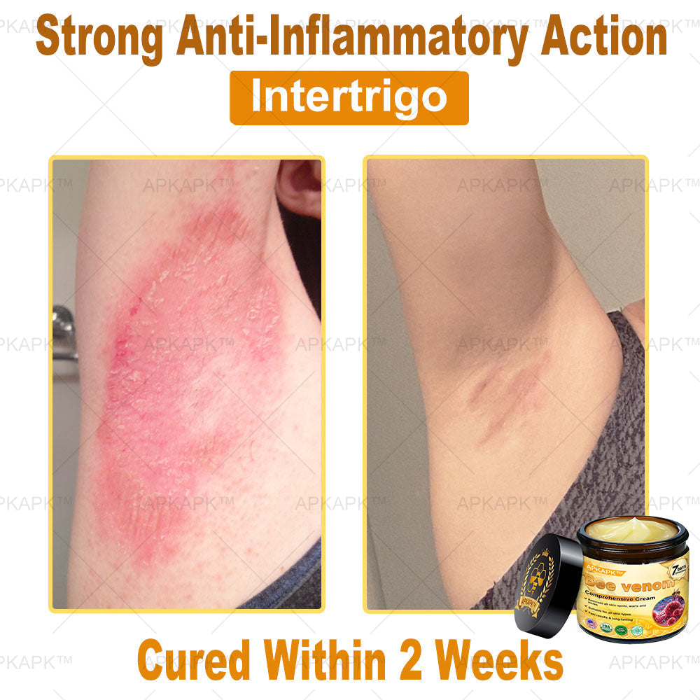 Skin Tags, Eczema, or Psoriasis? This 15-Minute Bee Venom Cream Soothes, Heals & Clears Fast—No Steroids, No Scars