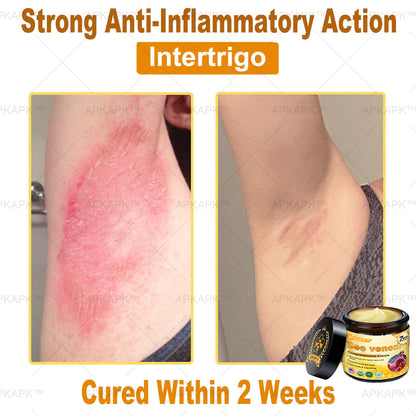 Skin Tags, Eczema, or Psoriasis? This 15-Minute Bee Venom Cream Soothes, Heals & Clears Fast—No Steroids, No Scars