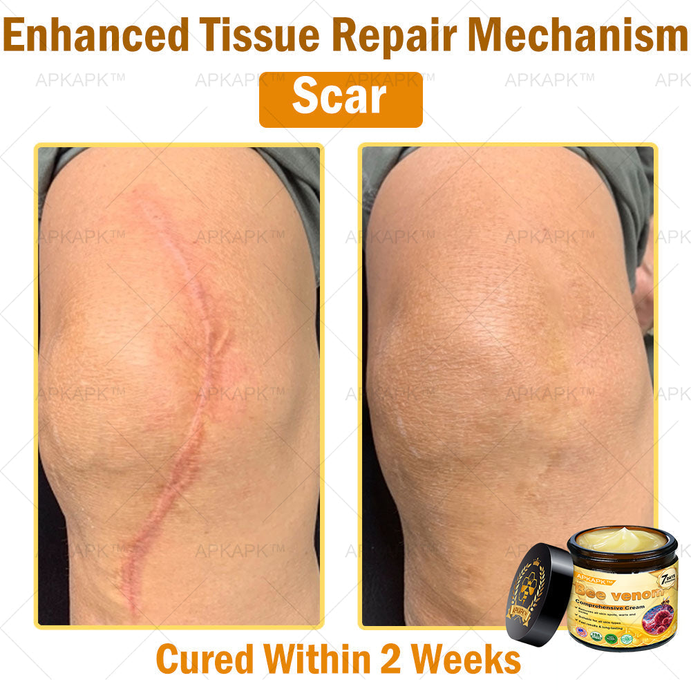 Skin Tags, Eczema, or Psoriasis? This 15-Minute Bee Venom Cream Soothes, Heals & Clears Fast—No Steroids, No Scars