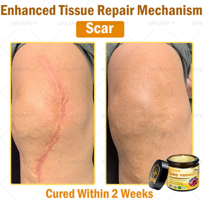 Skin Tags, Eczema, or Psoriasis? This 15-Minute Bee Venom Cream Soothes, Heals & Clears Fast—No Steroids, No Scars