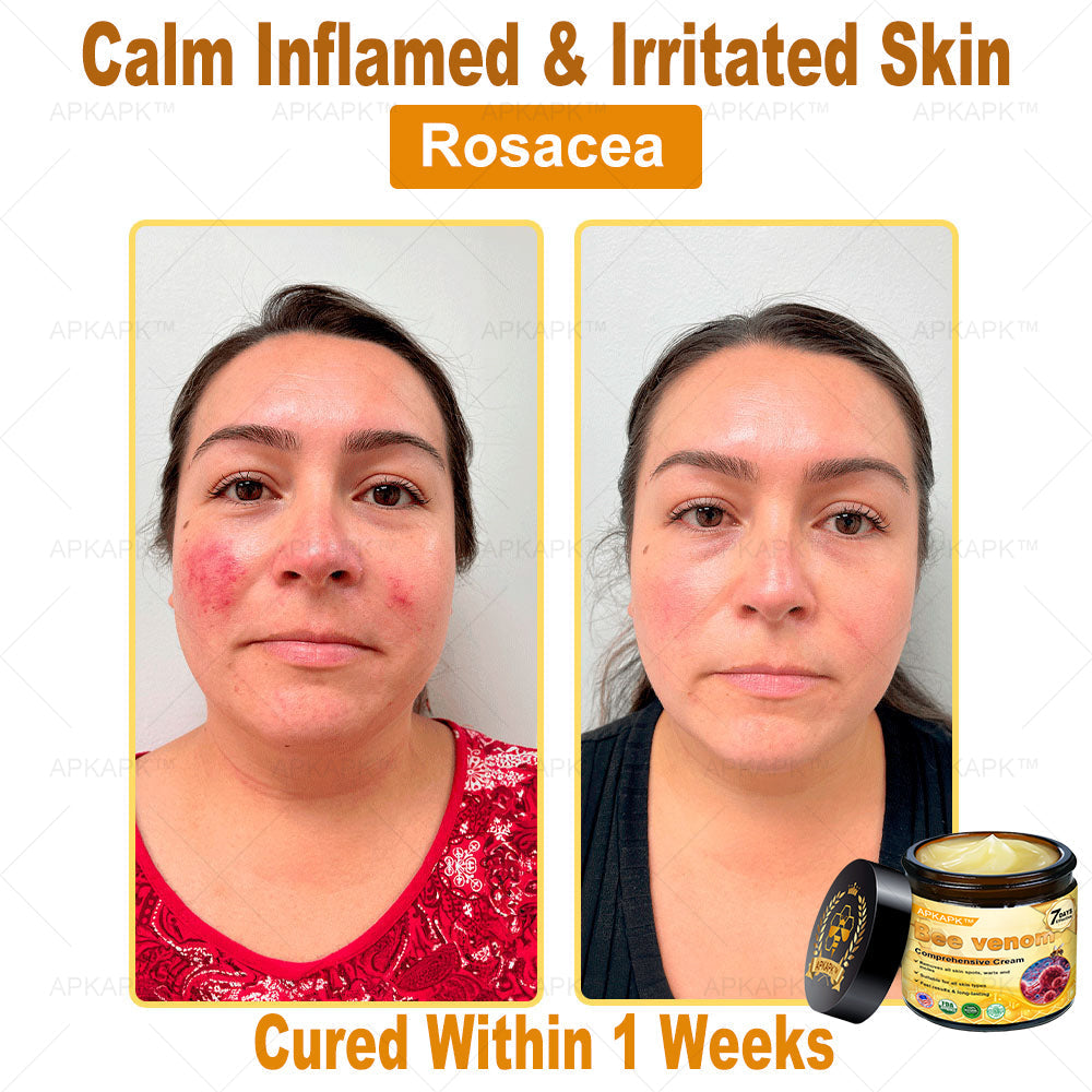 Skin Tags, Eczema, or Psoriasis? This 15-Minute Bee Venom Cream Soothes, Heals & Clears Fast—No Steroids, No Scars