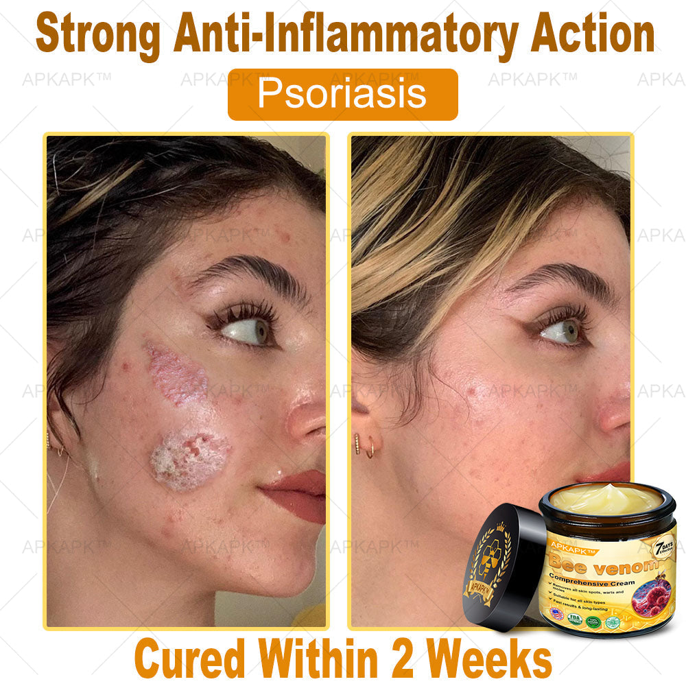 Skin Tags, Eczema, or Psoriasis? This 15-Minute Bee Venom Cream Soothes, Heals & Clears Fast—No Steroids, No Scars
