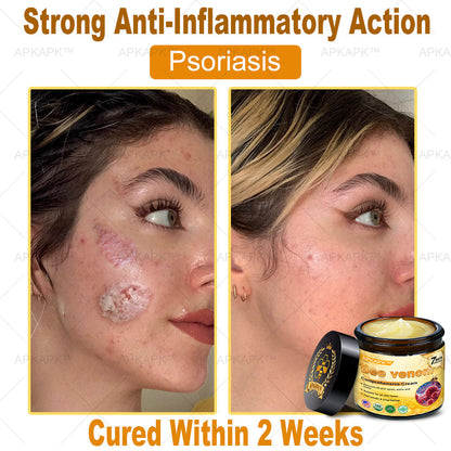 Skin Tags, Eczema, or Psoriasis? This 15-Minute Bee Venom Cream Soothes, Heals & Clears Fast—No Steroids, No Scars