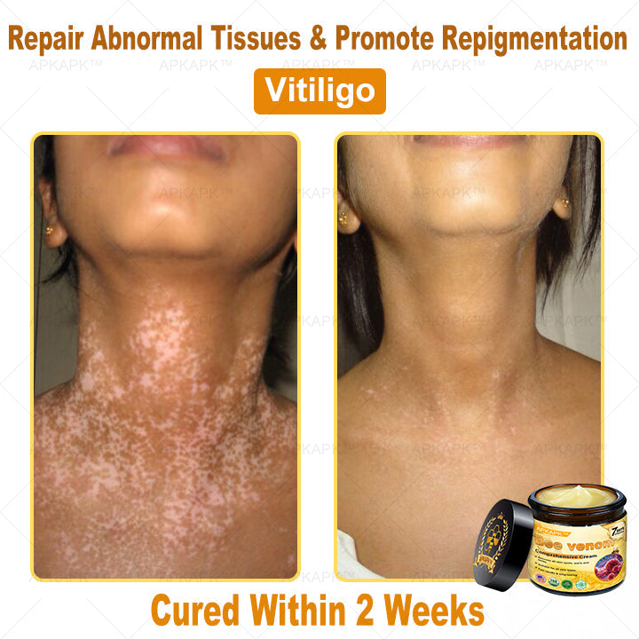 Skin Tags, Eczema, or Psoriasis? This 15-Minute Bee Venom Cream Soothes, Heals & Clears Fast—No Steroids, No Scars
