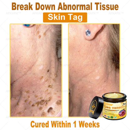 Skin Tags, Eczema, or Psoriasis? This 15-Minute Bee Venom Cream Soothes, Heals & Clears Fast—No Steroids, No Scars