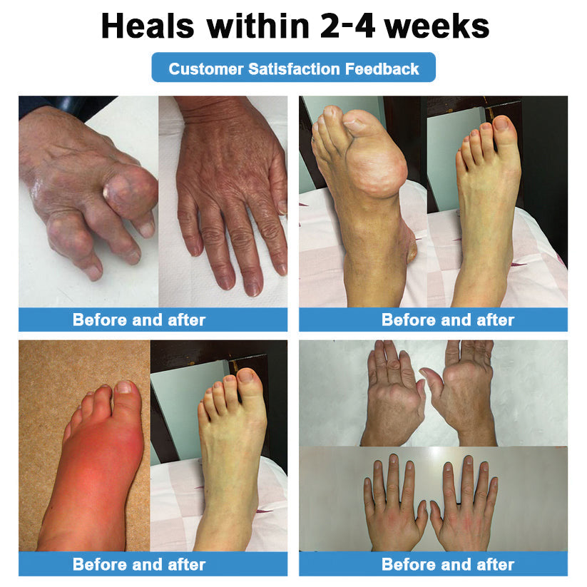 Official Store：👩‍⚕️Recommended by AAOS🦾ODALIT® Nano-microneedle joint patch (Painless, long-lasting, suitable for arthritis, varicose veins and various orthopedic diseases)