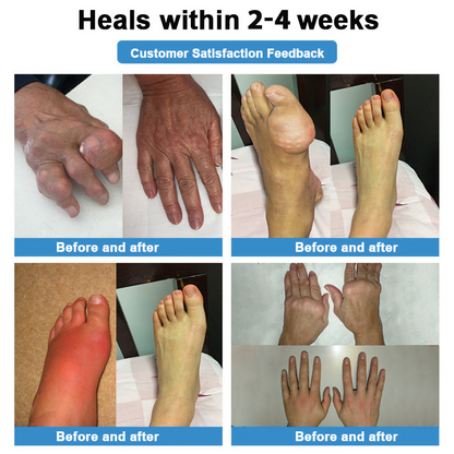 Official Store：👩‍⚕️Recommended by AAOS🦾ODALIT® Nano-microneedle joint patch (Painless, long-lasting, suitable for arthritis, varicose veins and various orthopedic diseases)