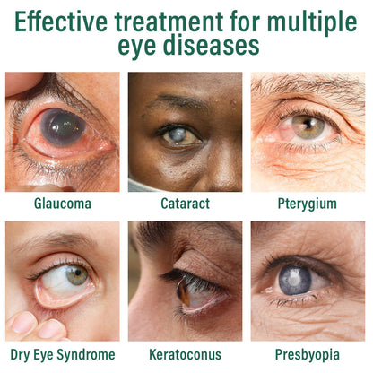 👩‍⚕️ODALIT™ Nano Eye Drops Serum ✅FDA Approved(Suitable for presbyopia, dry eye syndrome, glaucoma, and cataracts) ☘️☘️
