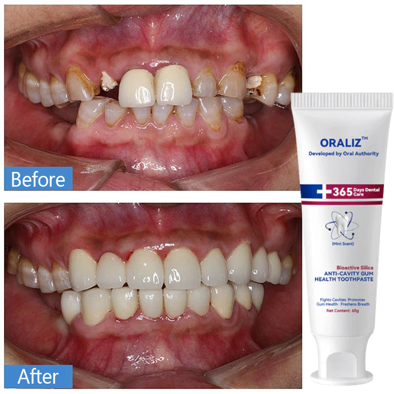 Oraliz™ Repair Teeth Anti-Decay - Hydroxyapatite Toothpastea