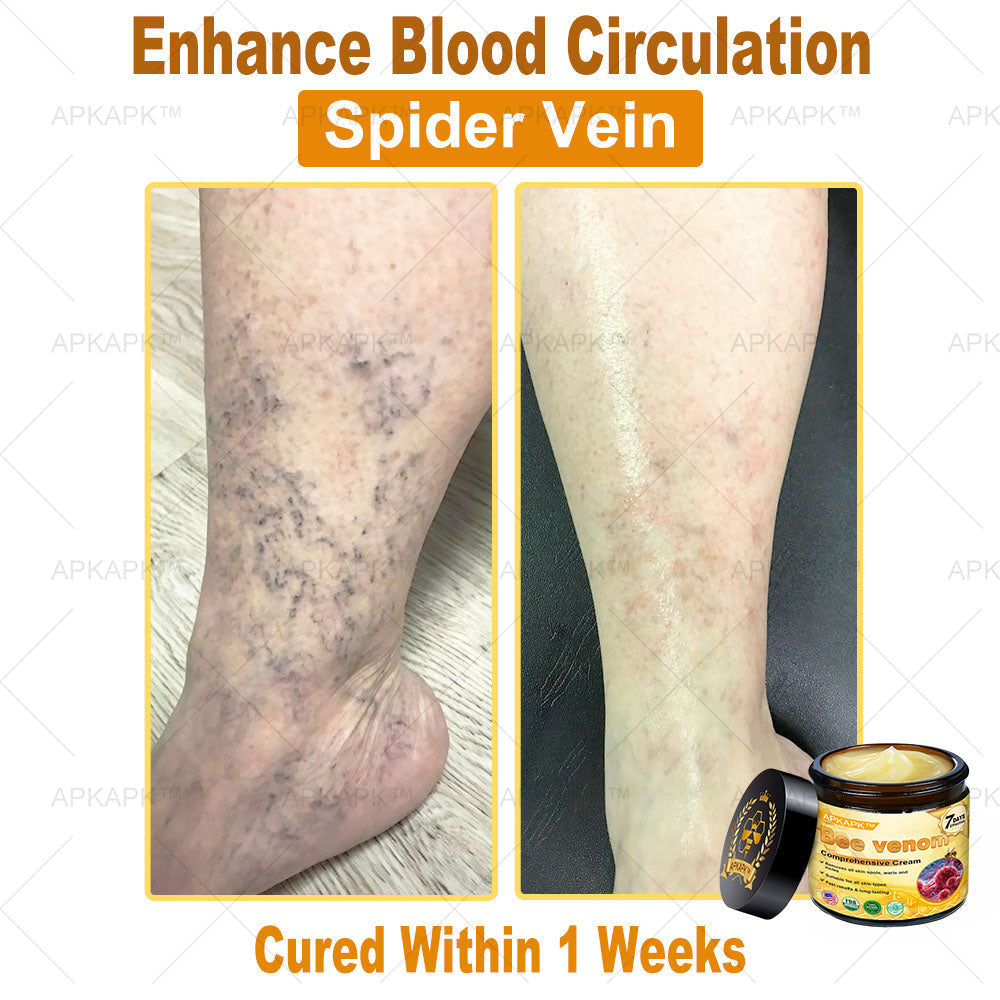 Skin Tags, Eczema, or Psoriasis? This 15-Minute Bee Venom Cream Soothes, Heals & Clears Fast—No Steroids, No Scars