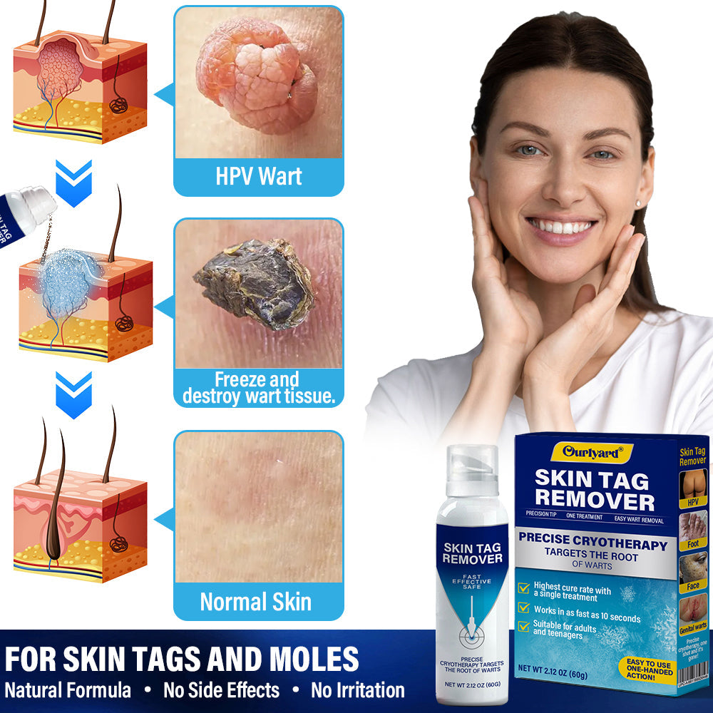 ✅Official Store |Ourlyard® TagRecede Cryo Treatment Spray |Removes warts and skin tags, suitable for all skin types. 🧡🧡