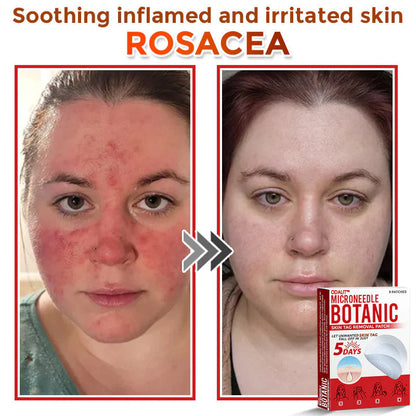 🌈ODALIT™ MicroNeedle Botanic Skin Tag Removal Patch 🇺🇸 Made in the USA