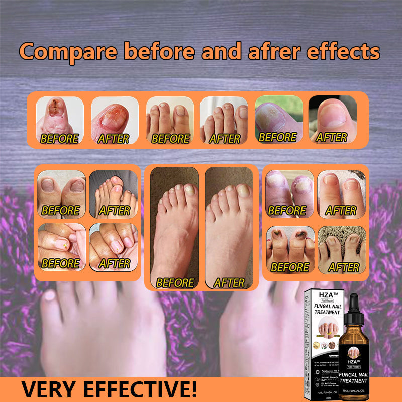 Final 5 Hours: 60% OFF🔥HZA™Fungal Nail Treatment