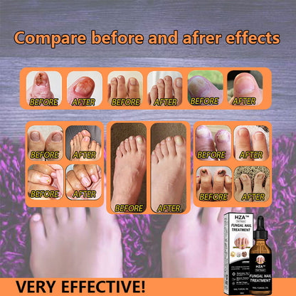 Final 5 Hours: 60% OFF🔥HZA™Fungal Nail Treatment