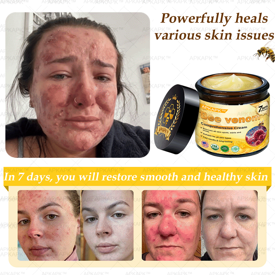 Skin Tags, Eczema, or Psoriasis? This 15-Minute Bee Venom Cream Soothes, Heals & Clears Fast—No Steroids, No Scars