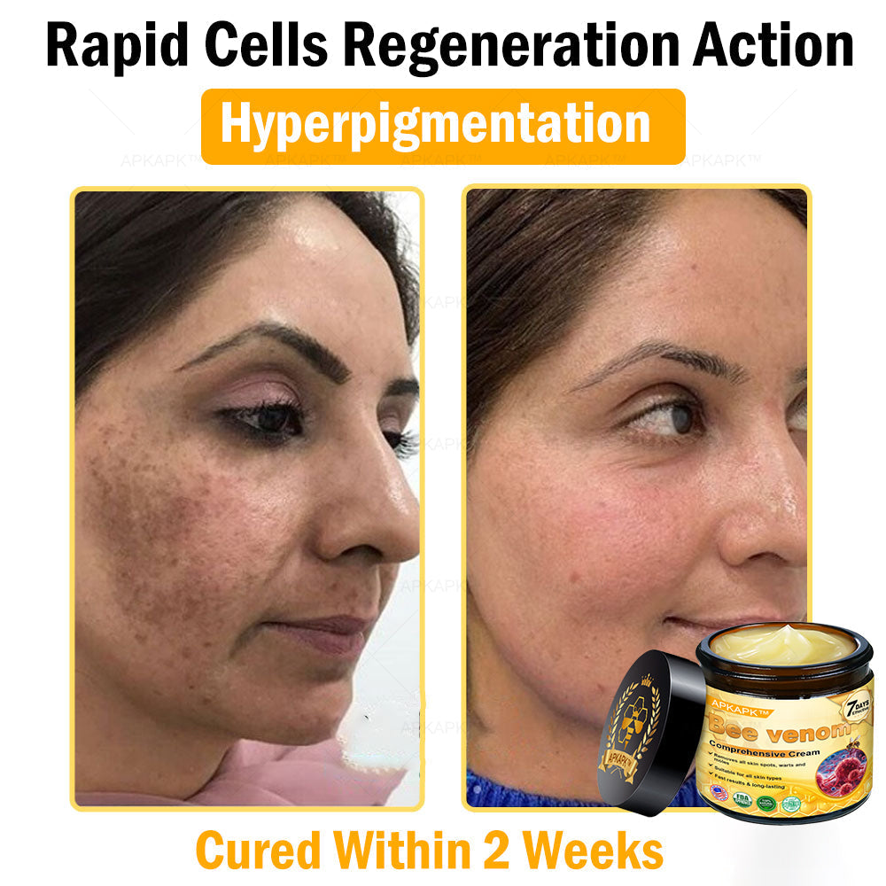Skin Tags, Eczema, or Psoriasis? This 15-Minute Bee Venom Cream Soothes, Heals & Clears Fast—No Steroids, No Scars