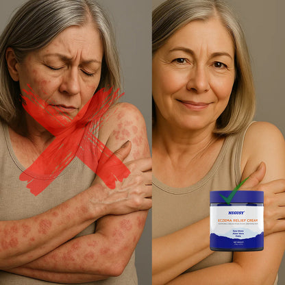 Barrier Renewal Remedy: ODALIT™ Eczema Relief Cream Stops Itchy, Red Flare-ups and Restores Clear, Healthy Skin in Just 30 Days