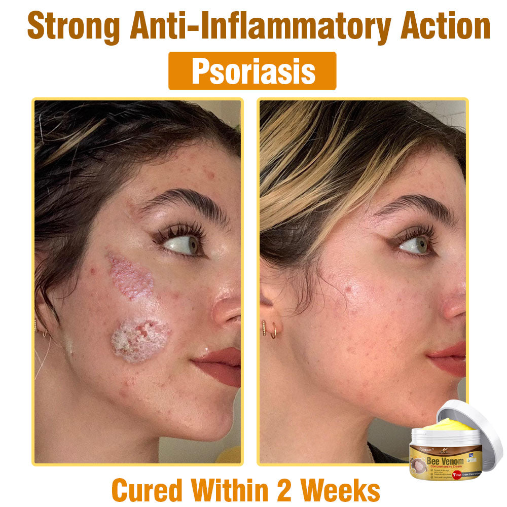 🐝 flysmus® Bee Venom Comprehensive Cream