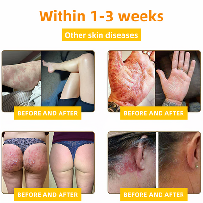 NESLEMY™ Bee Venom Skin Cream（👨‍⚕AAD Recommended),for Remove Warts, Acne and Scars