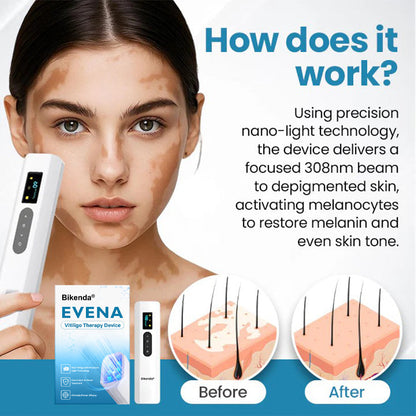 Bikenda® Evena Advanced Vitiligo Therapy Device