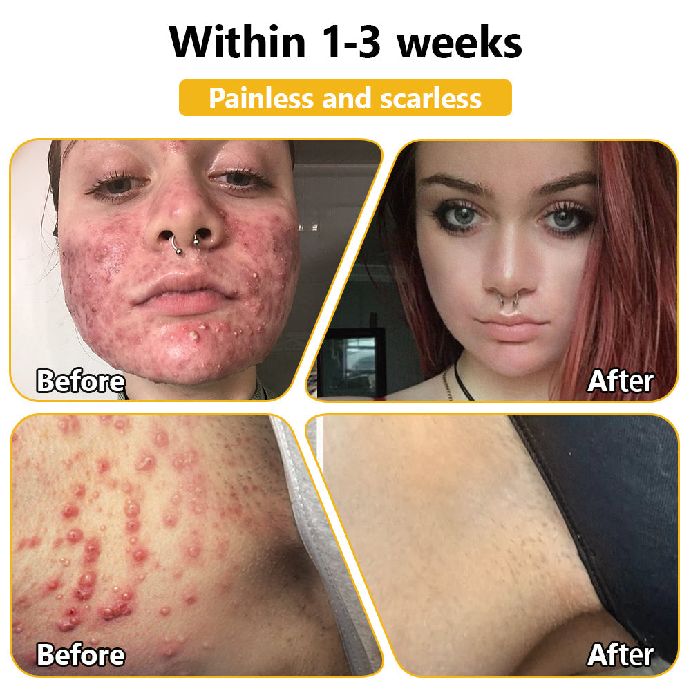 NEGUSY™ Bee Venom Skin Treatment Cream (AAD Recommended)