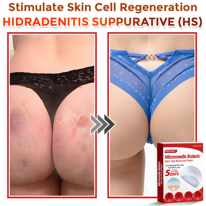 Negusy™ MicroNeedle Botanic Skin Tag Removal Patches – 🇺🇸 Made in the USA | Fast, Painless, Plant-Powered